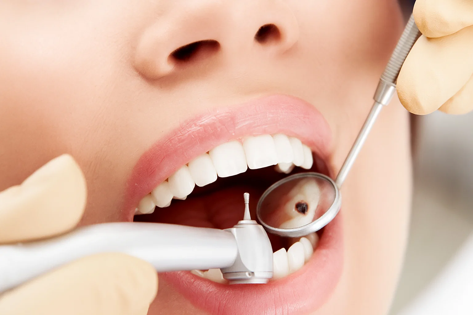 Лечение кариеса